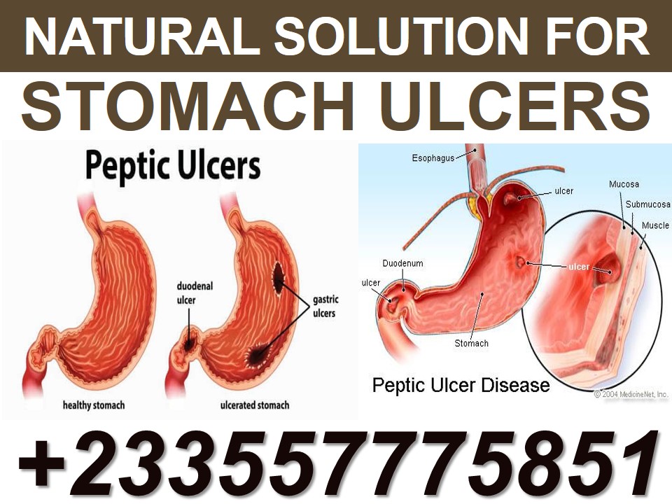 Treatment For Gastritis In Ghana