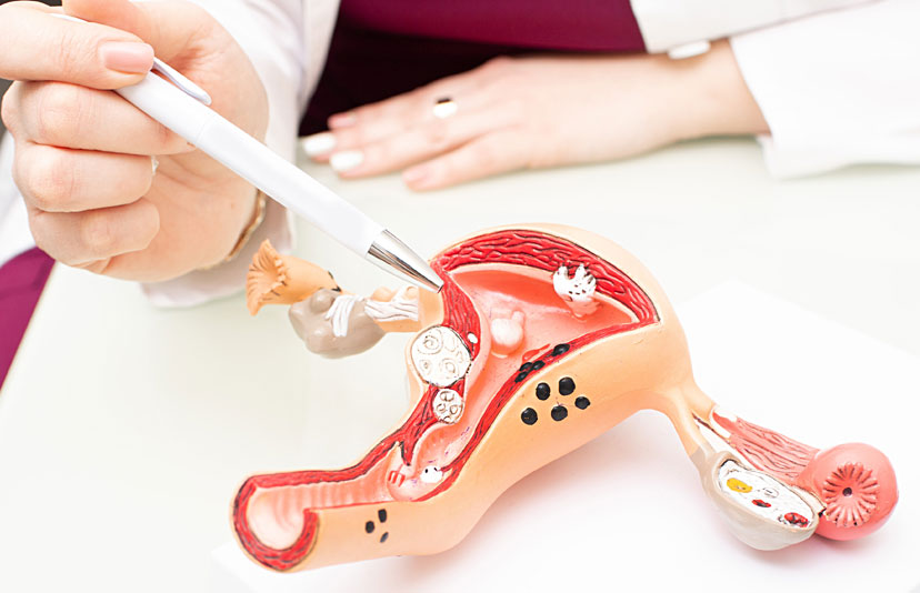 FIBROFIT - Tubal Blockage Fibroid Ovarian Cyst Candidiasis