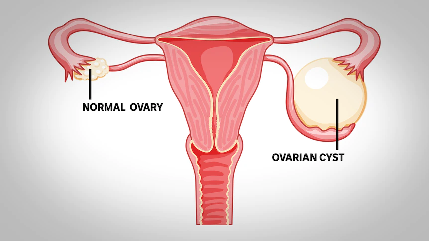 Genitaboost - Pelvic Inflammatory Disease (PID) Natural Remedy